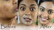 -Chin के दाने और कालापन दूर करने का सबसे आसान तरीका । Chin Ke Pimples or Kalapan Kaise Dur Kare