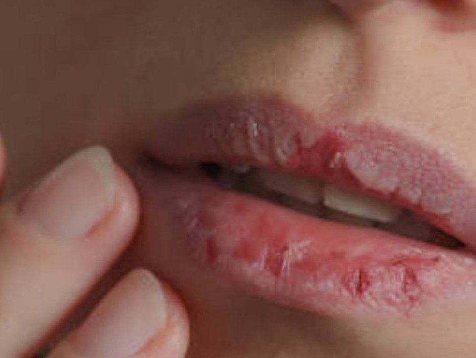 Kein Spaß beim Küssen? Das hilft gegen trockene Lippen!