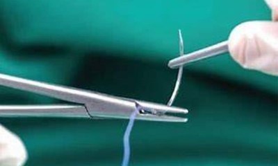 خيوط جراحية ذكية تراقب التئام الجروح