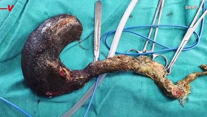 This Little Girl Is Recovering After a Mass of Her Own Hair Was Successfully Removed