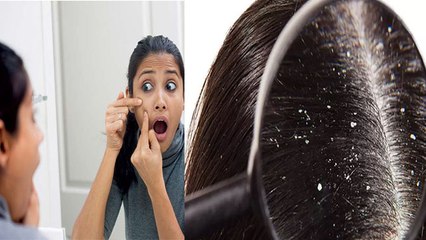 Face पर Pimple इस 1 कारण से भी होते है जाने कैसे करे बचाव | Boldsky