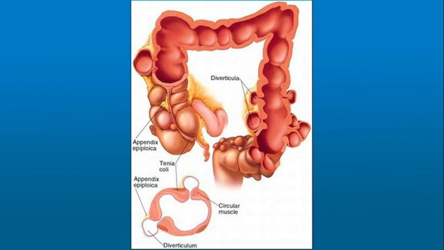 bd-diverticulos-causas-sintomas-y-tratamientos-280122
