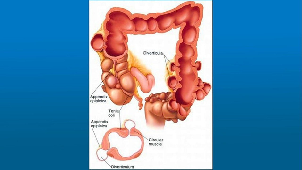 bd-diverticulos-causas-sintomas-y-tratamientos-280122