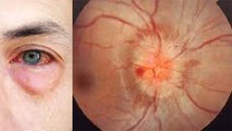 क्या है Optic Neuritis आंखो से जुड़ी एक गंभीर बीमारी जो बना देती है अंधा ! | Boldsky