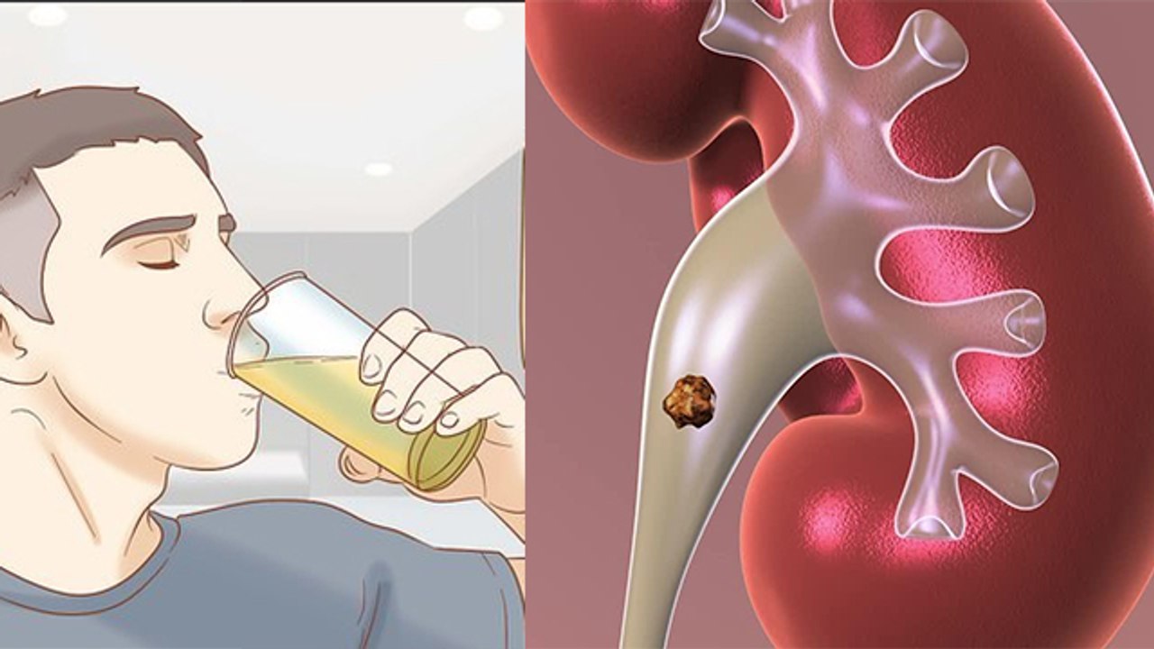 Aloe Vera Juice से Kidney Stone का जबरदस्त इलाज | Aloe Vera Good For Kidney Stone | Boldsky