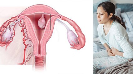 गर्भाशय पॉलीप क्या है, Symptoms नजरअंदाज करना खतरनाक | Uterine Polyp Kya Hai | Boldsky