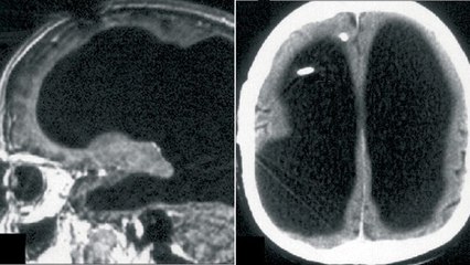 L'étrange cas de l'homme à qui il manque 90% de son cerveau... Mais qui se porte bien