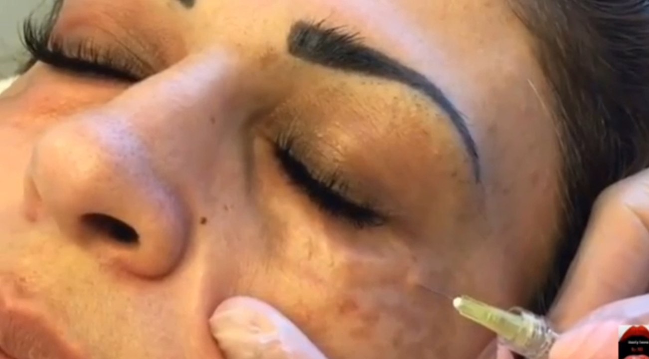 Carboxythérapie : le traitement impressionnant au dioxyde de carbone pour supprimer les cernes