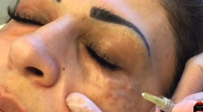 Carboxythérapie : le traitement impressionnant au dioxyde de carbone pour supprimer les cernes