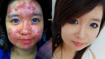 Dieses Mädchen leidet unter Akne. Aber wenn Sie sich schminkt, ist man verblüfft.
