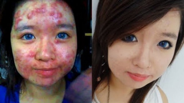 Dieses Mädchen leidet unter Akne. Aber wenn Sie sich schminkt, ist man verblüfft.