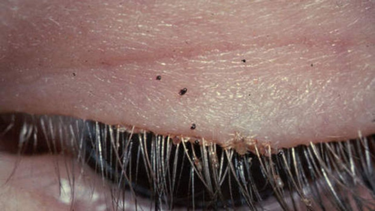 Beim näheren Heranzoomen entpuppte sich eine vermeintliche Augeninfektion als etwas ganz Anderes...