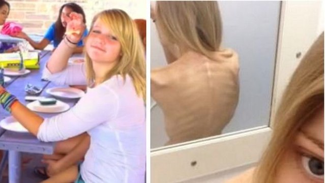 Sie begann mit einer einfachen Diät. Doch ihre Geschichte endete tragisch...