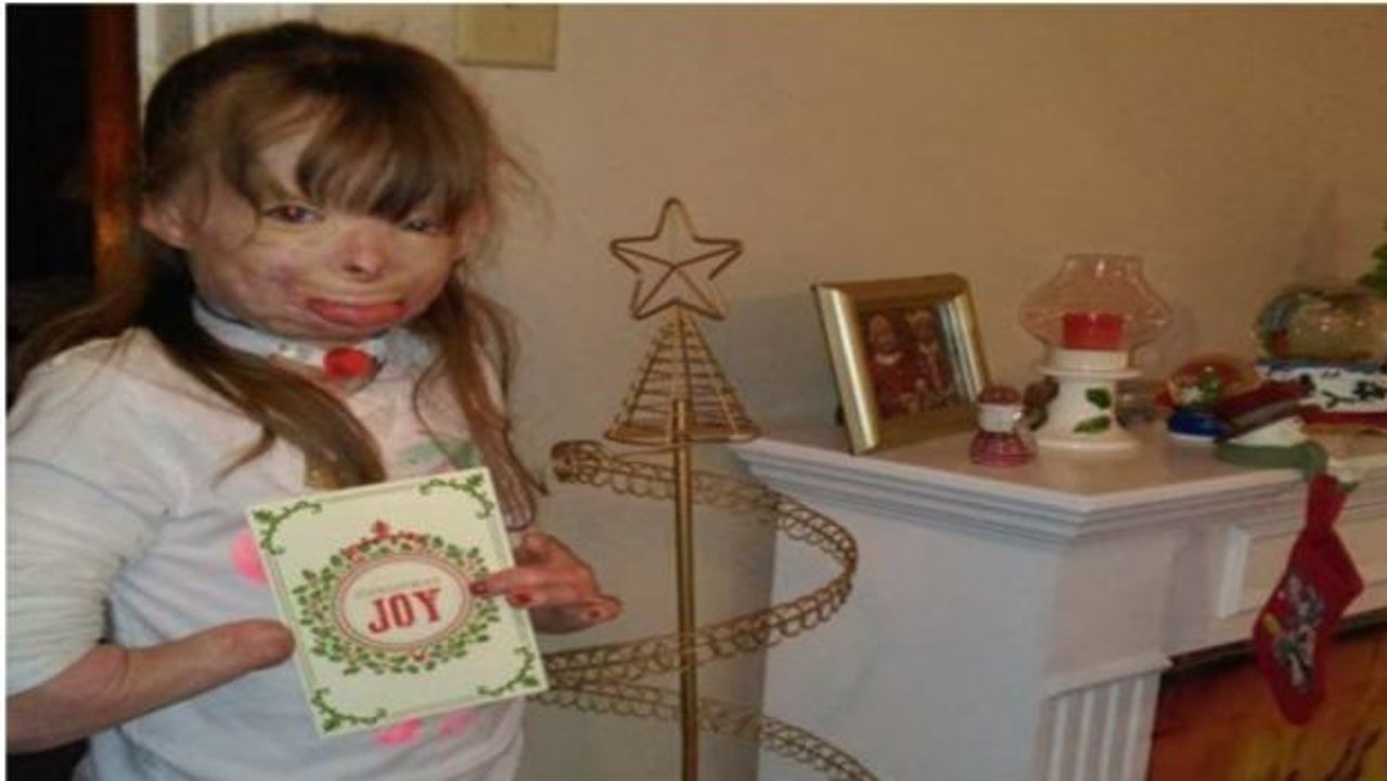Kleines Mädchen mit schwersten Verbrennungen wünscht sich nichts als Weihnachtskarten