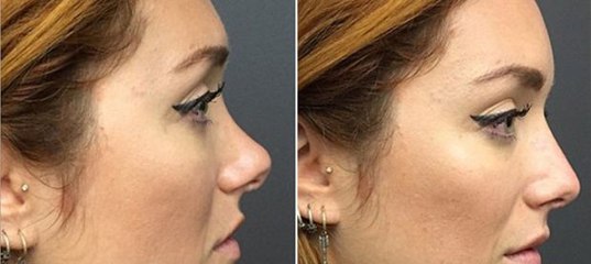 Nasenkorrektur leicht gemacht: in nur zehn Minuten und ohne chirurgischen Eingriff!