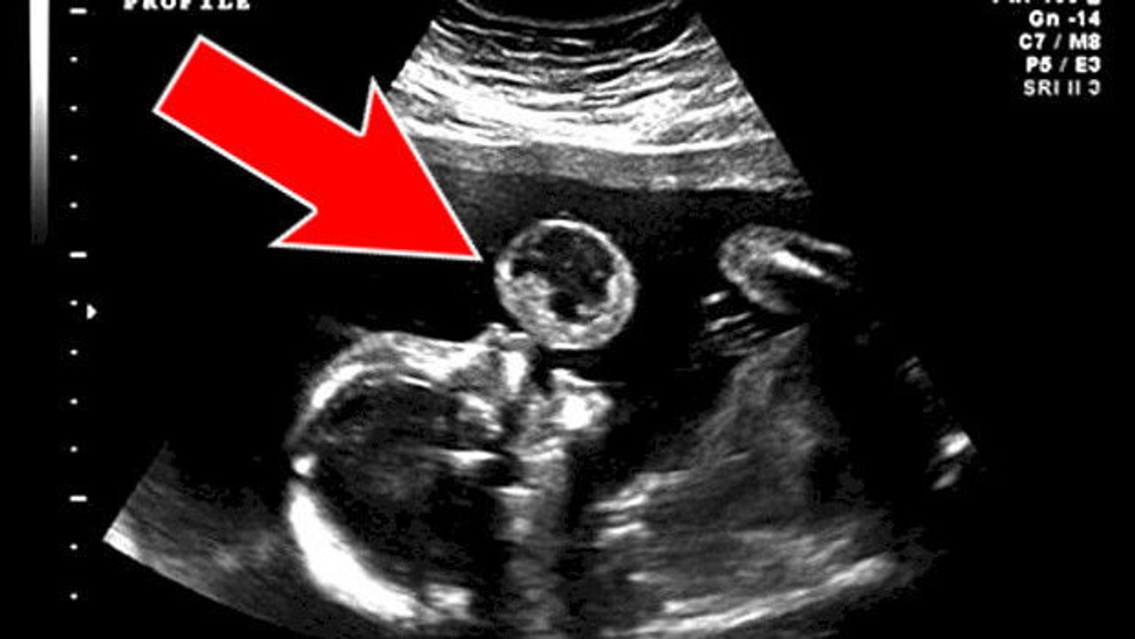 Der Ultraschall dieses Babys, das „eine Blase“ zu machen scheint, bringt eine schreckliche Wahrheit ans Licht