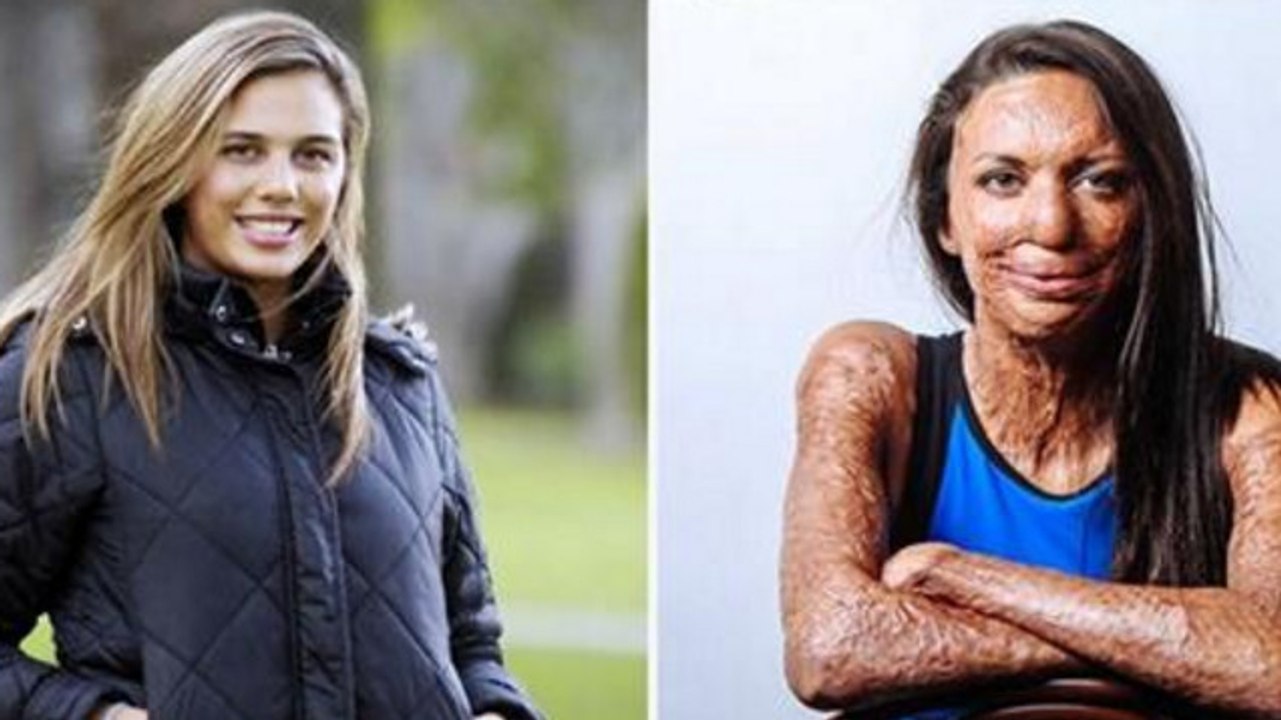 Trotz Verbrennungen dritten Grades hat diese Frau den besten Mann der Welt