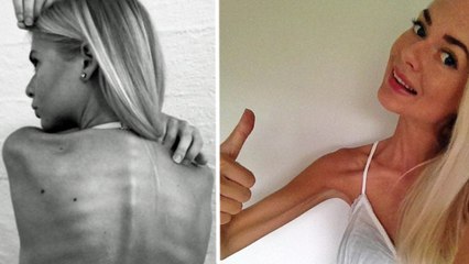 Sie ist extrem magersüchtig: Dann verändert sie ihren Körper radikal!