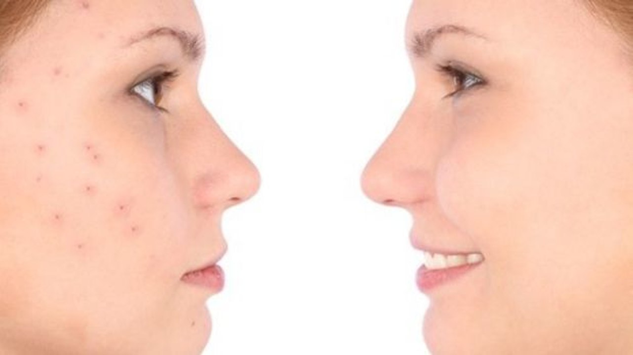 Entdecke 4 Mittel gegen Akne, die oft ignoriert werden