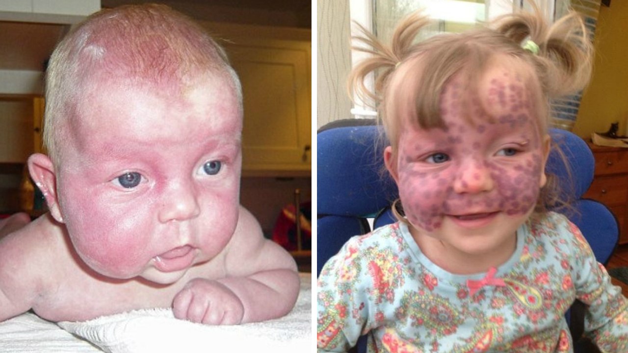 Fünfjähriges Mädchen mit seltener Krankheit bewegt das Netz