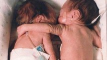 Einem der beiden Frühchen-Zwillinge ging es schlecht, da legte die Krankenschwester die beiden Babys zusammen