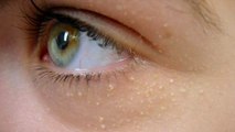 Grießkörner (Milien): Was sind die Ursachen von Grießkörnern unter den Augen, und wie entfernt man sie