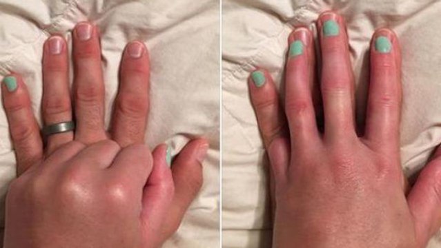 Die wundervolle Geste eines Mannes für seine Frau, der ein Finger amputiert wurde