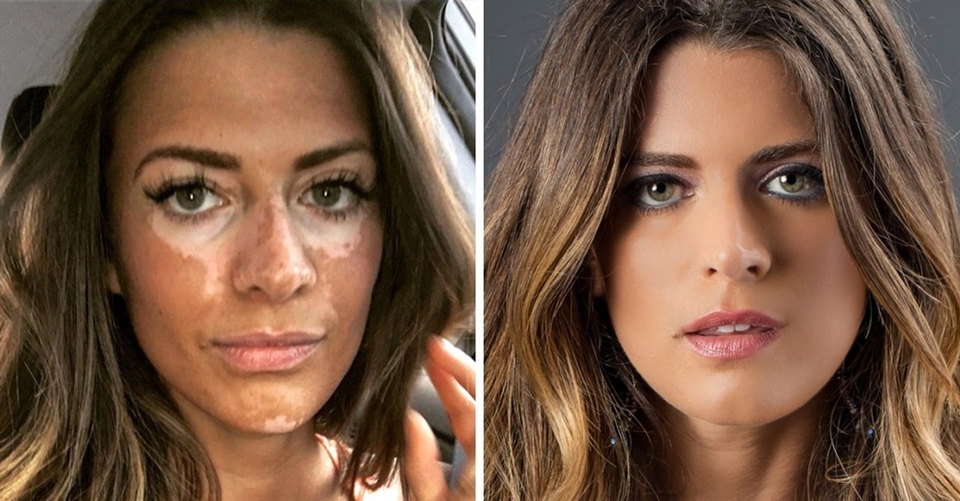 Vitiligo: Ursache, Symptome, Behandlung, Leben mit der Krankheit