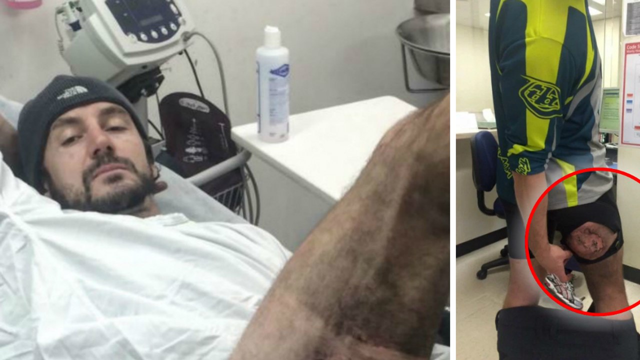 Gareth Clear: Infolge eines Fahrradunfalls überhitzt das iPhone in seiner Hose und bleibt an seiner Haut kleben