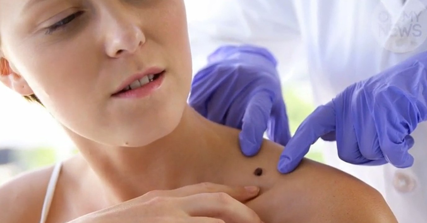 Gefährliche Muttermale selbstständig Zuhause erkennen. So geht es!