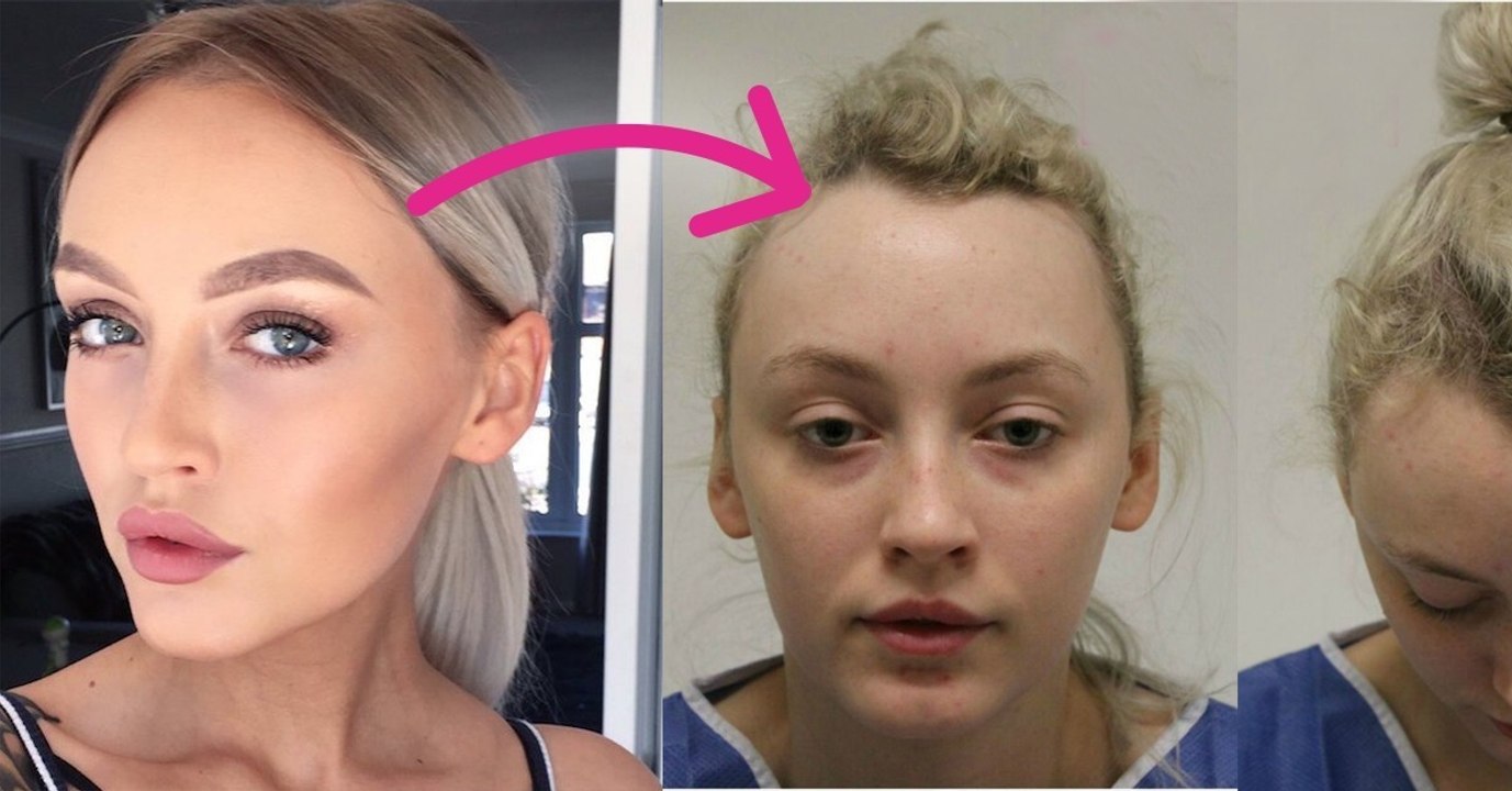 Diese ehemalige Tänzerin zeigt die desaströsen Folgen von täglich hochgesteckten Haaren