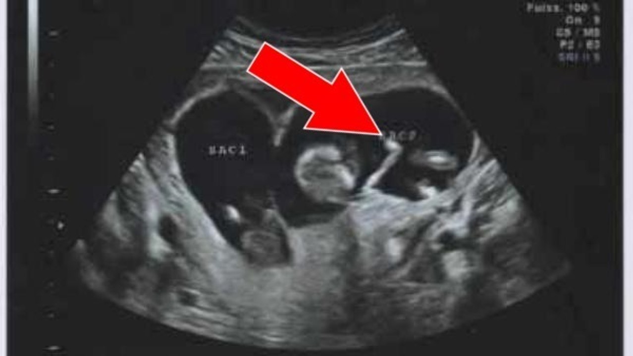 Nach einer Fehlgeburt lebt ihr Baby am Ende doch!