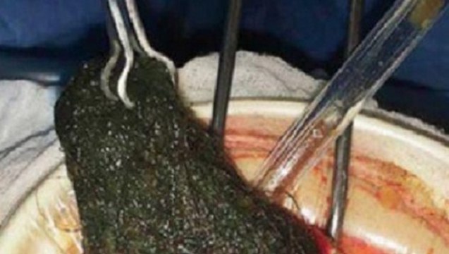 Trichophagie: Ärzte machen grausige Entdeckung im Magen einer jungen Frau