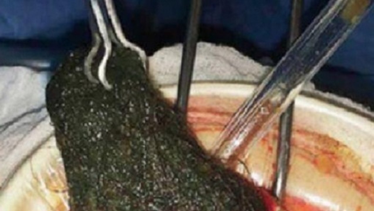 Trichophagie: Ärzte machen grausige Entdeckung im Magen einer jungen Frau
