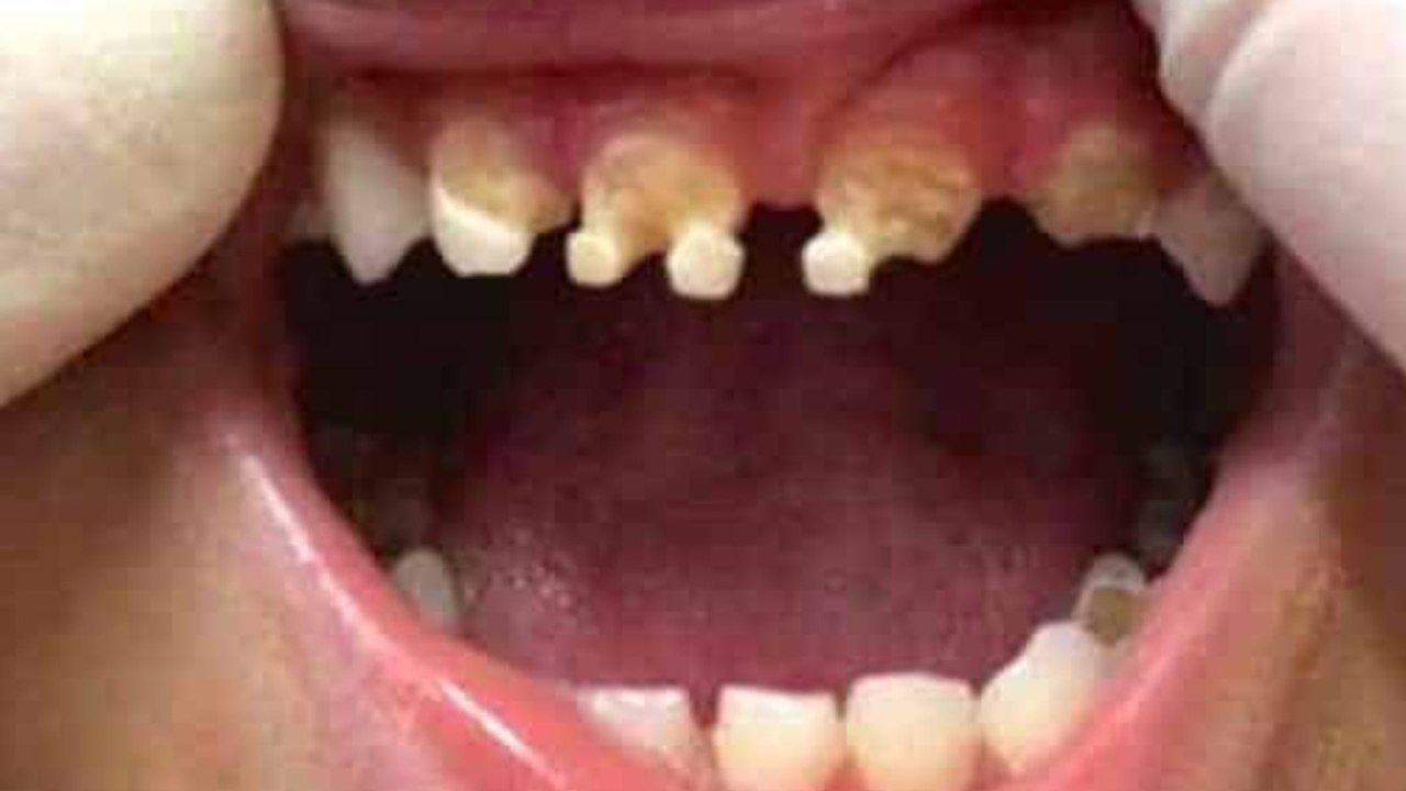 Dieses Kind hat vom Zucker ganz schlechte Zähne bekommen!