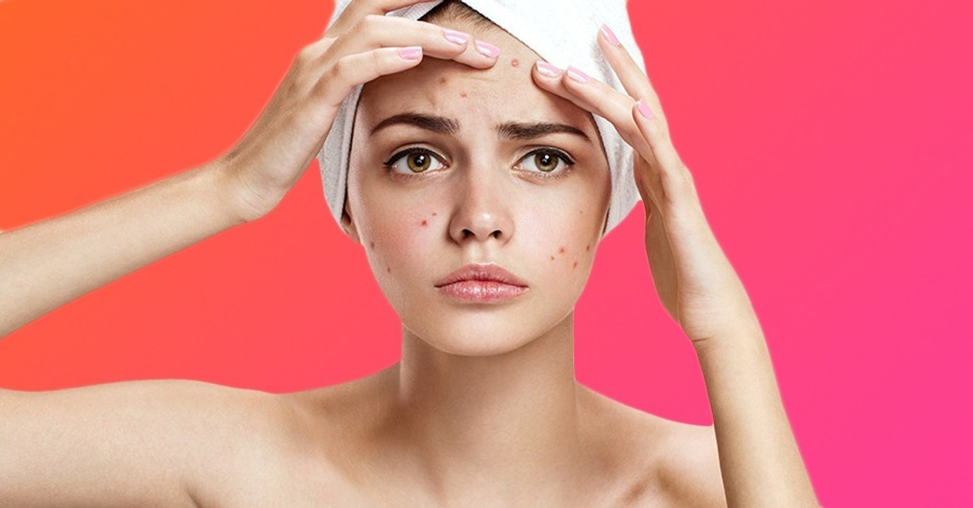 Nach Ansicht der Wissenschaftler soll Akne die Haut jung halten