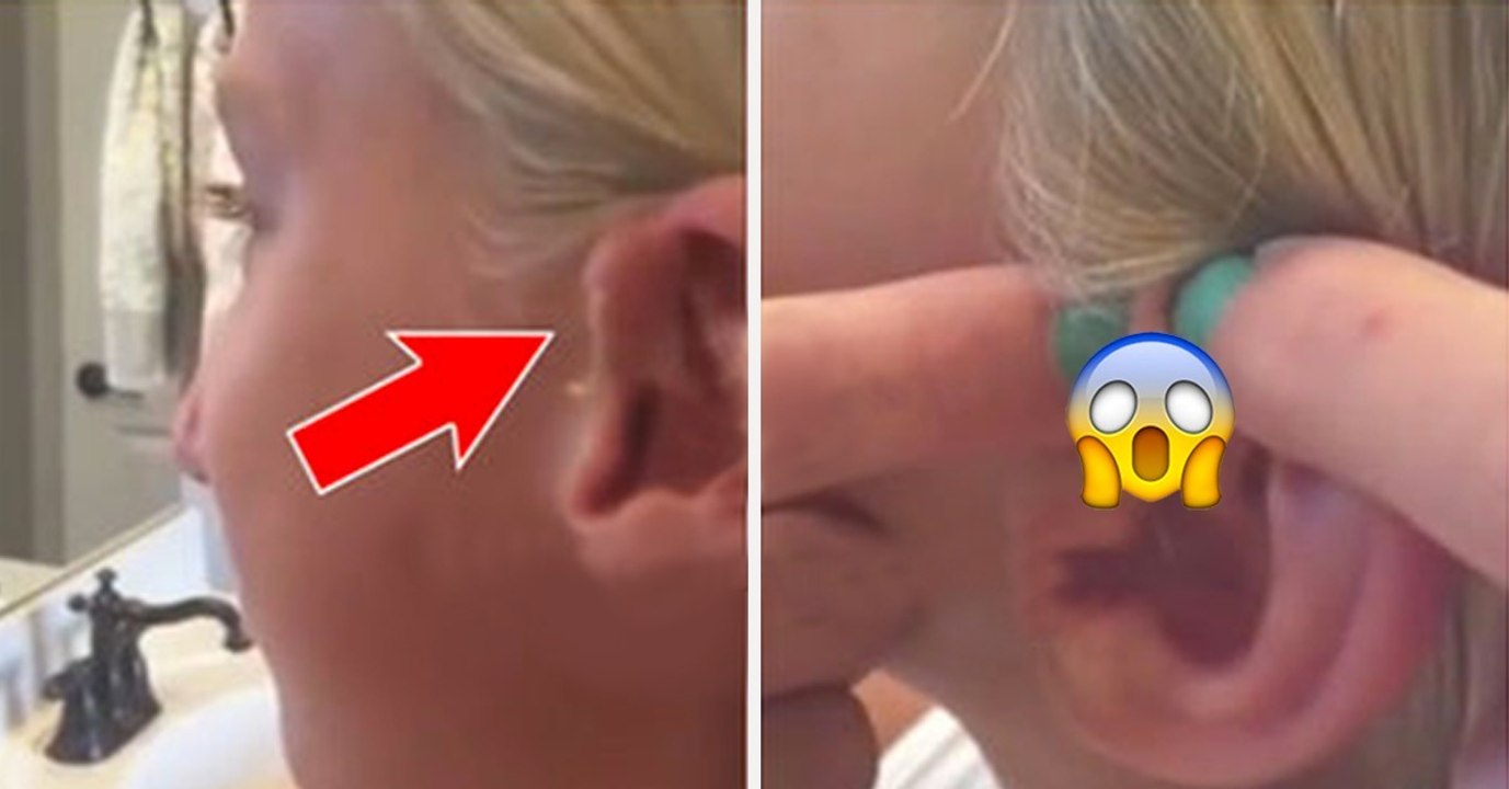 Nach 6 Jahren: Frau drückt Pickel am Ohr aus!