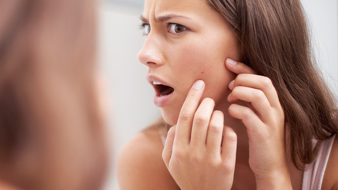 Follikel-Filamente sind keine Mitesser und dürfen nicht ausgedrückt werden