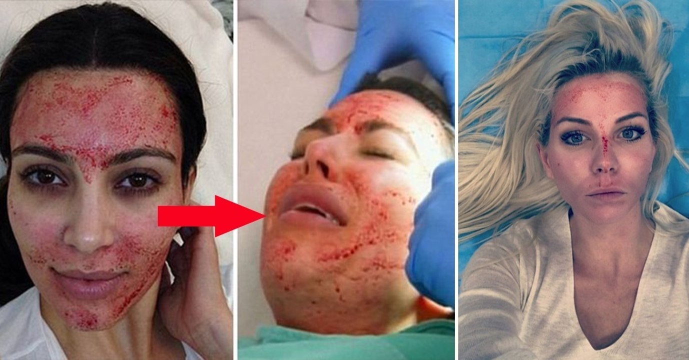 Vampir Lifting: Die neue Technik zur Regeneration und Verjüngung der Haut der Stars