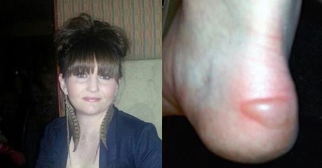 Frau bekommt Blase wegen hoher Schuhe: Das hat fatale Folgen für ihre Gesundheit