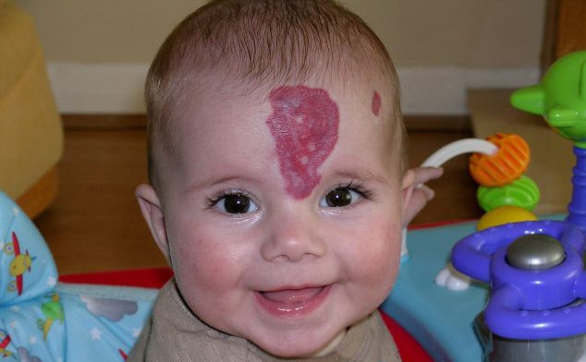 Was wurde aus dem Baby mit dem riesigen Muttermal auf der Stirn?