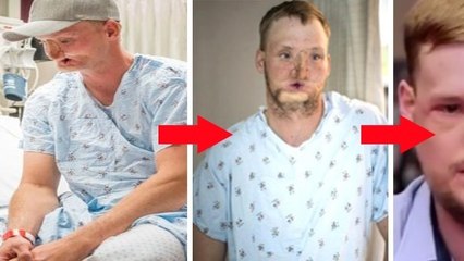 Sein Gesicht ist komplett zerstört, doch einige Jahre später passiert, worauf er nicht mehr zu hoffen wagte!