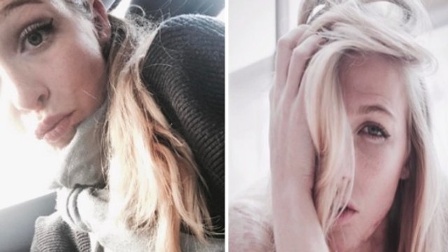 Diese junge Frau verbrannte durch einen Unfall an 40% ihres Körpers