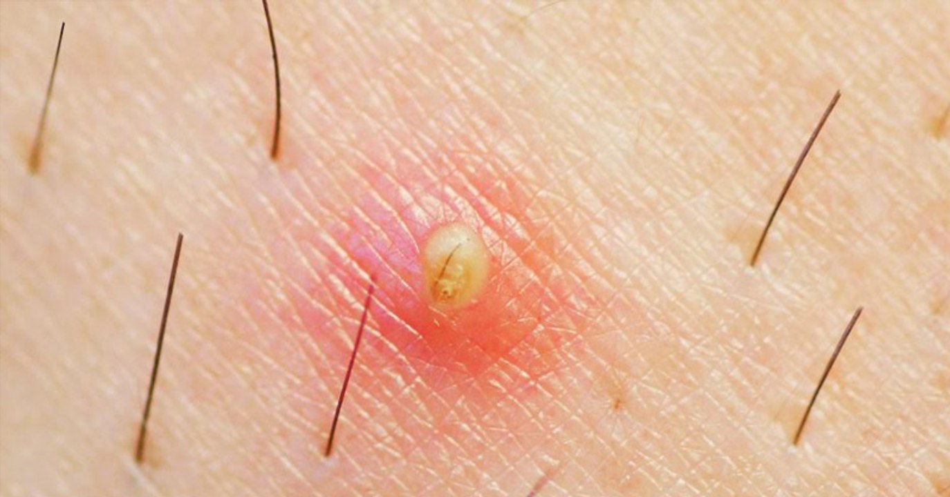 Eingewachsenes Haar mit Alaunstein entfernen: Entzündung und Eiter vermeiden