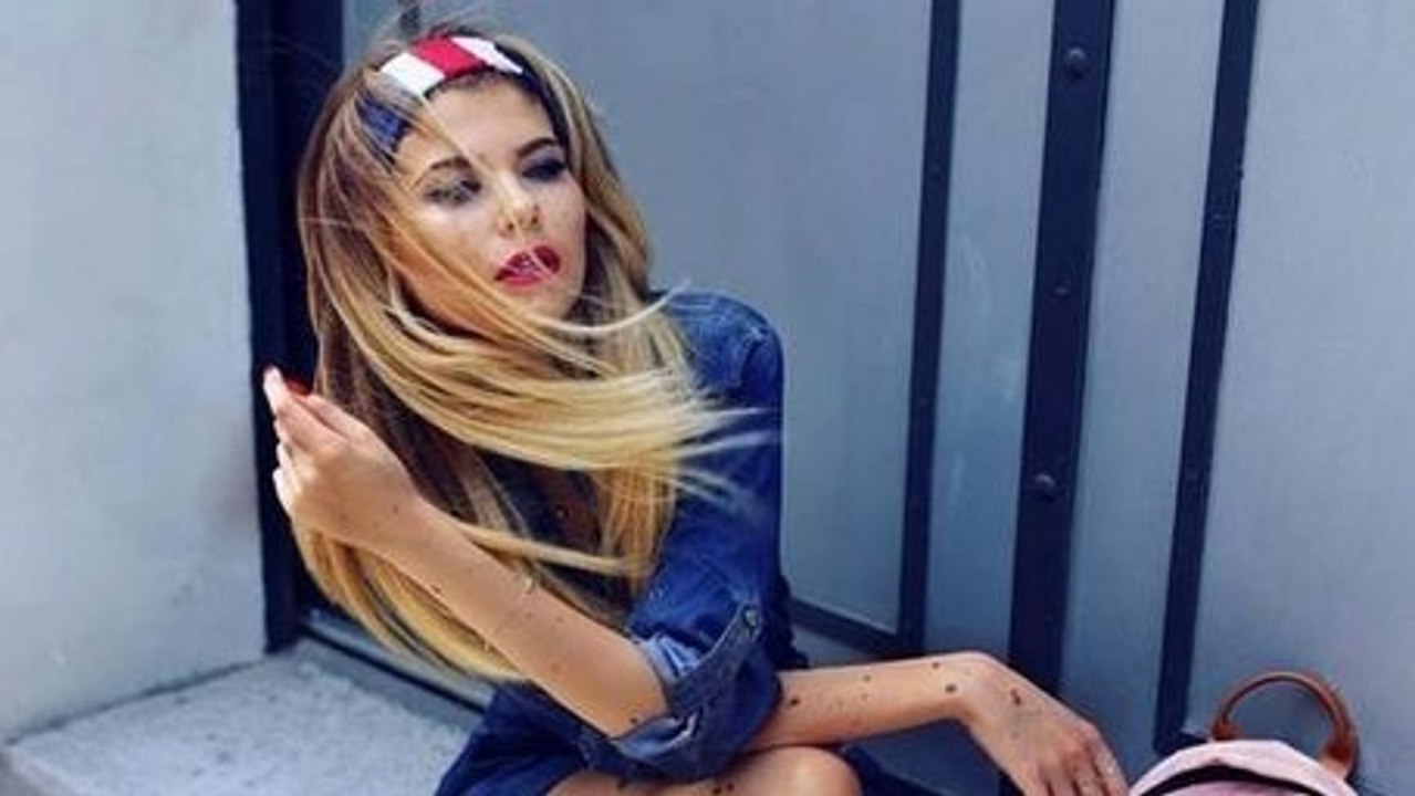 Eine Ukrainerin kommt mit einem Gendefekt zu Welt und wird damit zum Star auf Instagram