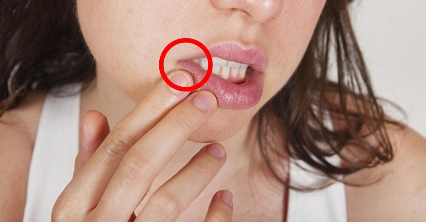 Risse in den Mundwinkeln: Ursache und Lösung