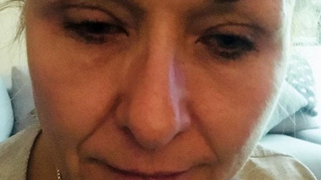 Sie schminkt sich 25 Jahre lang nicht ab. Dann geht sie zum Arzt und bekommt die Diagnose!