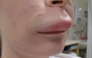 Frau hat geschwollene Lippe. So etwas haben die Ärzte noch nie gesehen!