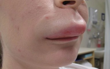 Frau hat geschwollene Lippe. So etwas haben die Ärzte noch nie gesehen!