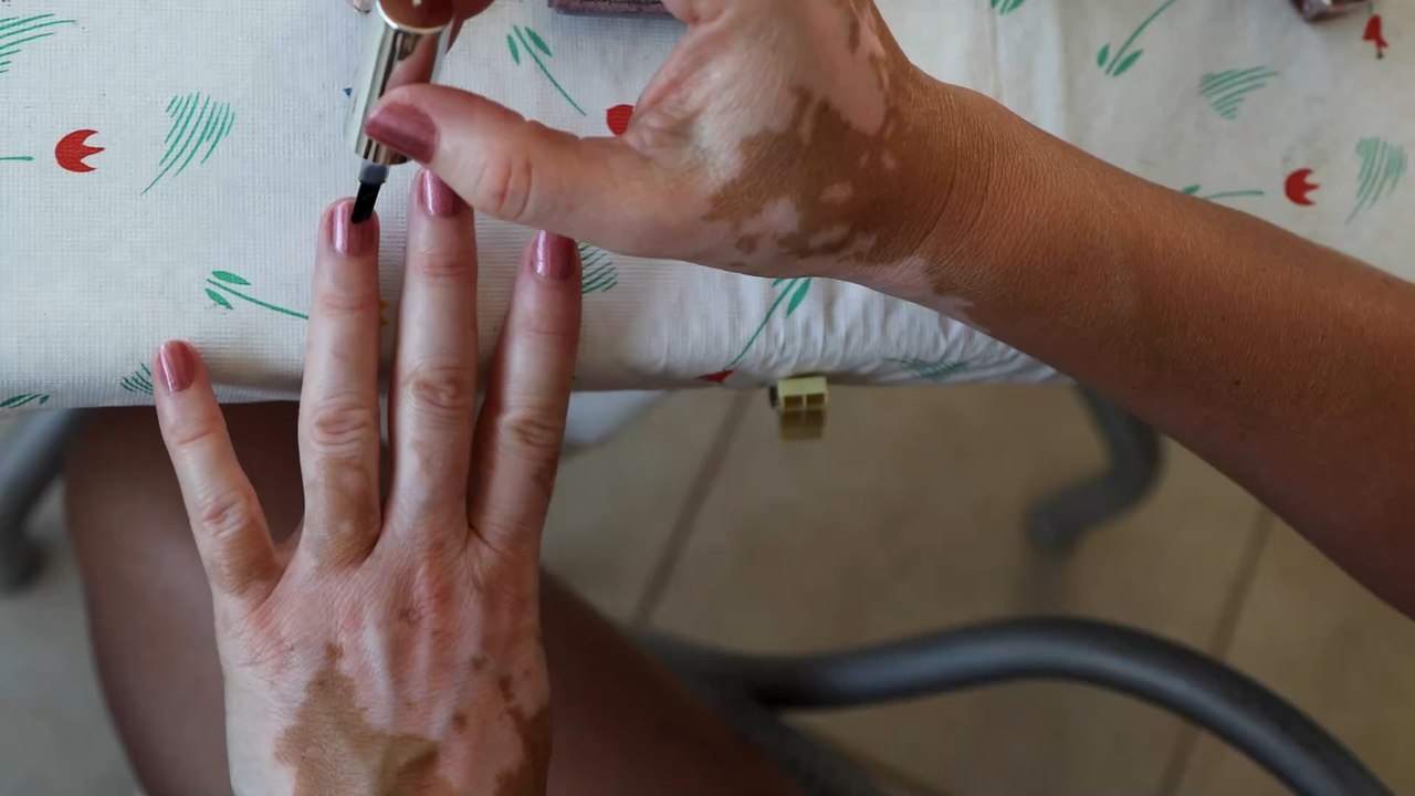 Streifen auf dem Nagel: Frau sieht darin sofort Anzeichen für eine schlimme Krankheit